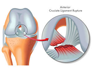ACL rupture ACL reconstruction dr mike smith dr chien-wen liew minimally invasive single hamstring technique adelaide south australia