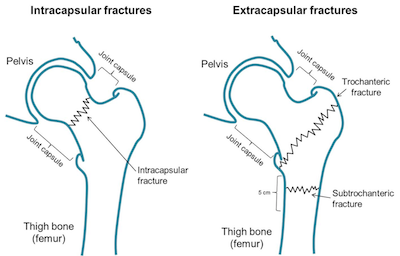 extracapsular fractures adelaide hip trauma surgery dr mike smith dr chien-wen liew orthopaedics 360 robotics
