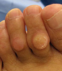 Mike smith adelaide orthopaedic surgeon bunion surgery lesser toe deformity bent toes best photo