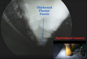 Plantar fascia released via keyhole dr mike smith orthopaedic surgeon adelaide plantar fasciitis