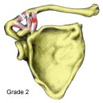 Acj Rupture Acromioclavicular Joint Adelaide Sprain Surgery Shoulder Dr Chien Wen Liew