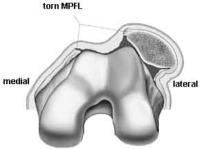 adelaide orthopaedic knee surgeon patella dislocation mpfl tear