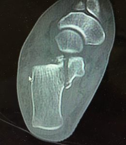 adelaide orthopaedic surgeon mike smith ankle sprain treatment calcaneus fracture