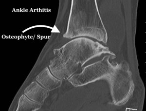 ankle arthritis CT scan treatment of ankle pain adelaide orthopaedic surgeon mike smith