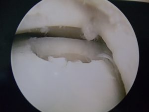 ankle arthritis cartilage damage mike smith ankle surgeon adelaide arthroscopy best image