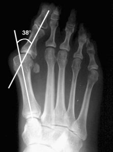 dr mike smith foot surgeon adelaide bunion treatment bunion surgery xray