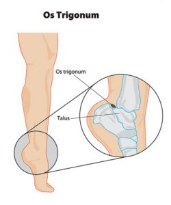 mike smith adelaide ankle surgeon os trigonum surgery ankle pain impingement best image
