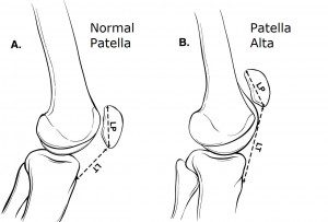 patella dislocation treatment mike smith knee surgeon patella alta