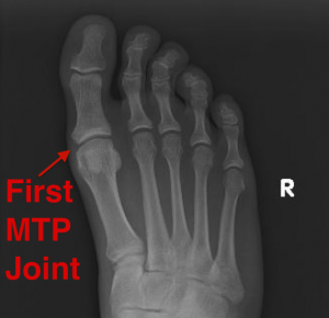 1st mtp joint osteoarthritis)