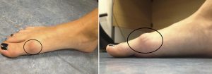 toe spur from arthritis mike smith