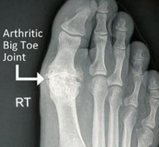 mike smith toe arthritis management
