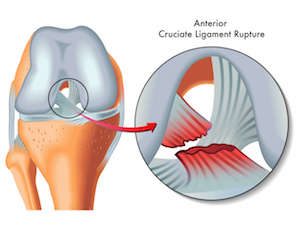 ACL rupture ACL reconstruction dr mike smith dr chien-wen liew minimally invasive single hamstring technique adelaide south australia