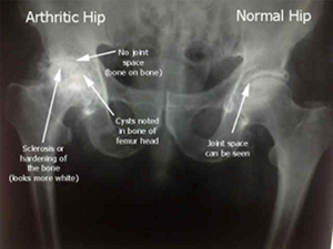 hip arthritis orthopaedic surgeon adelaide south australia minimally invasive hip replacement direct anterior approach best diagram