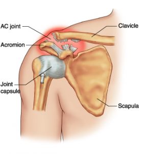ACJ dislocation shoulder surgeon dr chien-wen liew adelaide hip and knee