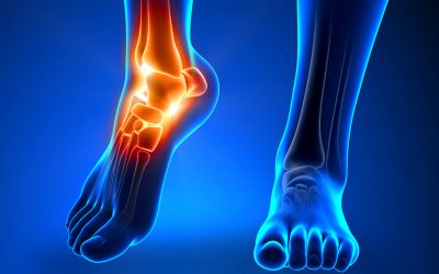 Pain following Ankle Sprain