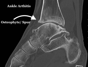 mike smith adelaide orthopaedic surgeon ankle arthritis arthroscopy ankle pain bunion surgery plantar fasciitis