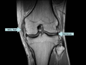 MRI MCL tear treatment knee surgeon adelaide recovery time