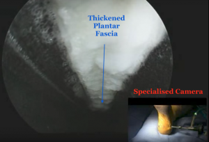 Plantar fascia released via keyhole dr mike smith orthopaedic surgeon adelaide