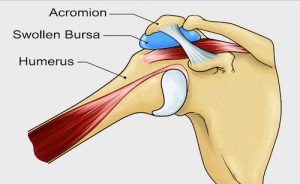 arthroscopic stabilisation shoulder labral repair adelaide south australia liew surgeon