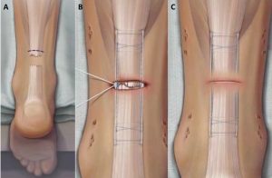 achilles tendon rupture repair using minimally invasive techniques mike smith
