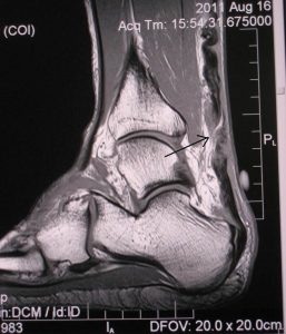 achilles tendon rupture mike smith adelaide orthopaedic surgeon recovery