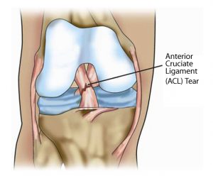 acl-dr-chien-wen-liew-minimally-invasive-knee-and-hip-surgeon-adelaide-south-australia