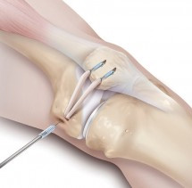 adelaide orthopaedic knee surgeon patella dislocation best position mpfl