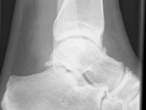 anterior ankle impingement mike smith orthopaedic surgeon adelaide