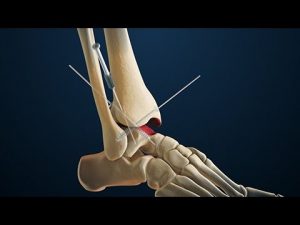mike smith adelaide orthopaedic surgeon ankle arthritis ankle pain bunion surgery plantar fasciitis