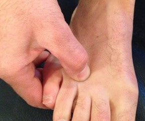 mortons neuroma pain foot surgery mike smith