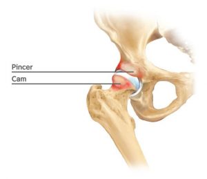 hip femoroacetabular impingement Adelaide Dr Chien-Wen Liew Hip replacement arthroscopy surgeon adelaide hip and knee