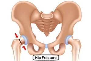 hip fracture surgery adelaide austofix dr mike smith emergency surgery hip replacement dr chien-wen liew