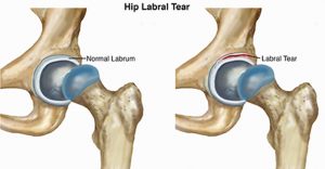 hip labral tear adelaide hip and knee surgeon dr chien-wen liew arthroscopic hip surgery best photo
