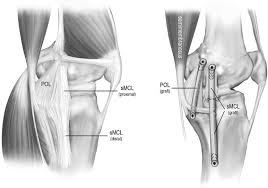 knee surgeon adelaide MCL tear mike smith