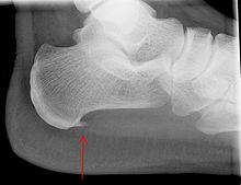 Heel Spur Treatment - Moore Foot & Ankle | Spring, TX-gemektower.com.vn