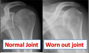 shoulder arthritis adelaide burnside dr chien-wen liew total shoulder replacement