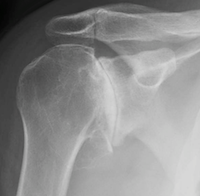 shoulder arthritis adelaide total shoulder reverse replacement dr chien-wen liew adelaide orthopaedic surgeon