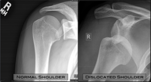 shoulder dislocation surgery adelaide dr chien-wen liew shoulder minimally invasive best xray