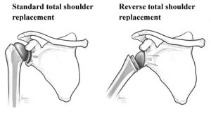 total shoulder replacement adelaide shoulder dr chien-wen liew orthopaedic surgeon south australia