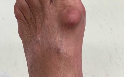 Can you have a bunion deformity and still have a straight toe?